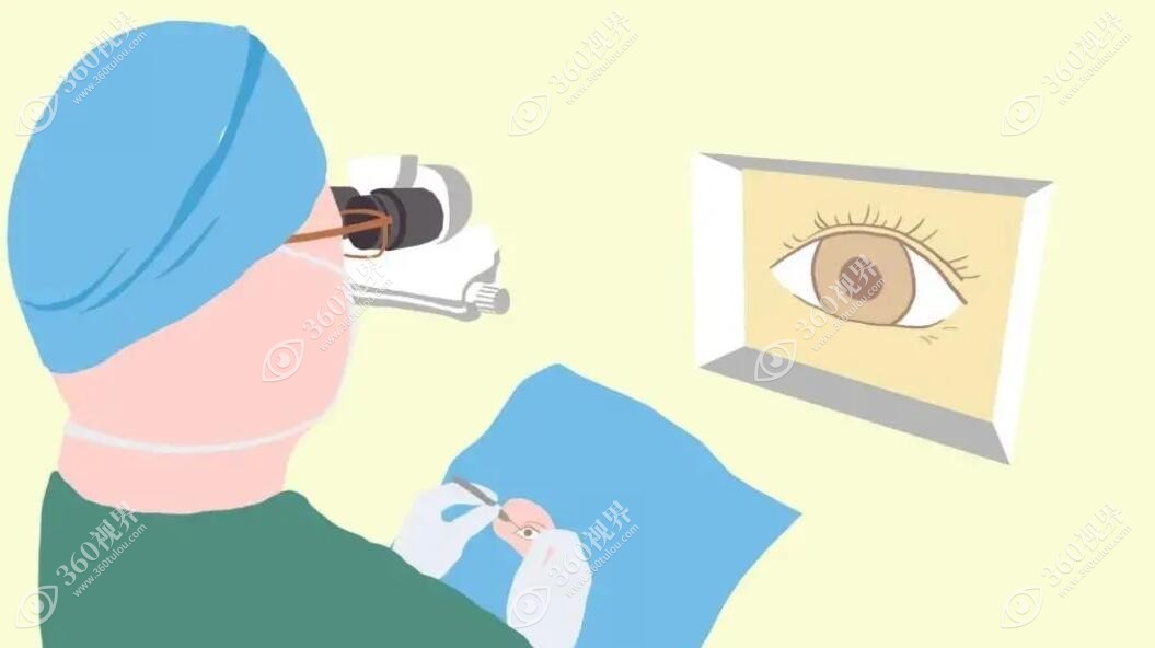 近视眼手术卡通图
