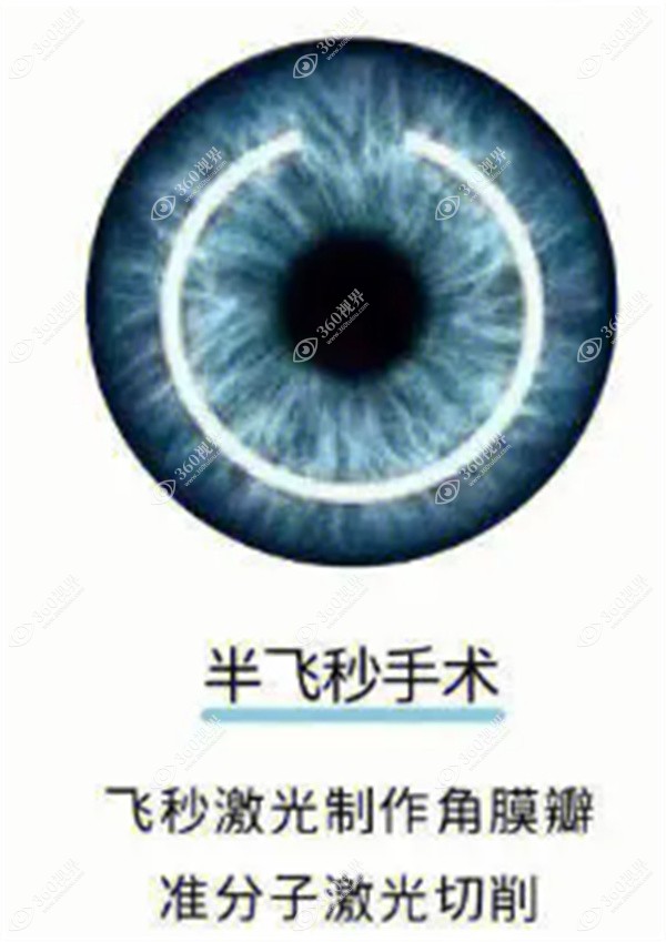 深圳半飞秒手术价格