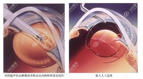 做了icl以后可以做白内障手术且不会影响术后恢复。360tulou.com