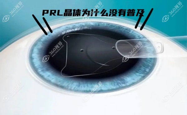 PRL晶体为什么没有普及?仅适合1000-3000超高度近视且不带散光