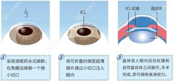 成都铭依眼科做icl晶体植入手术好