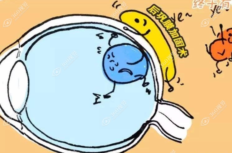 后巩膜加固术能维持多久