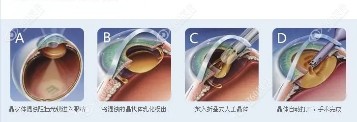 屈光性晶体置换术是主流手术，主要适用于老视门诊科室内