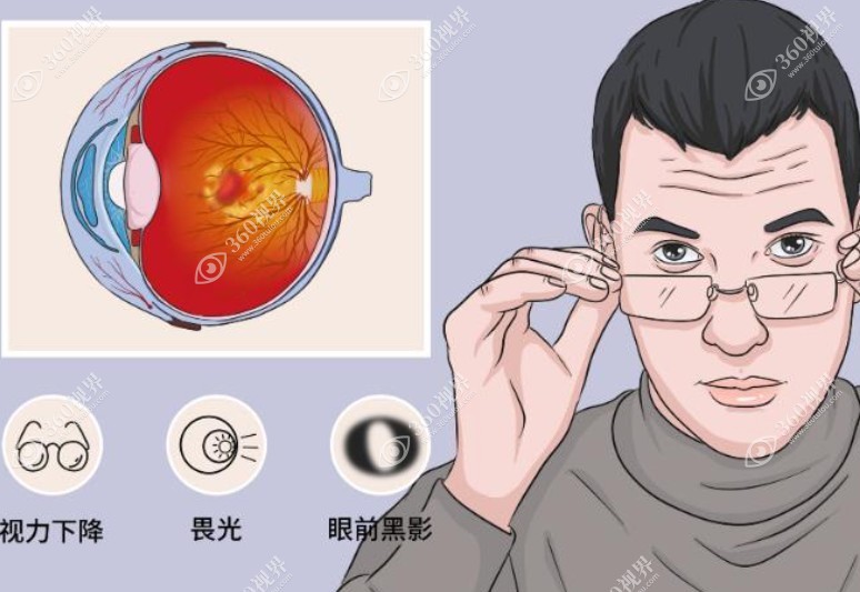 视网膜脱落手术是大手术但风险小