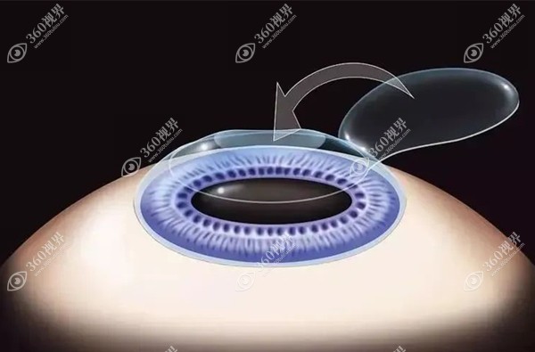 圆锥角膜不能做激光手术的原因