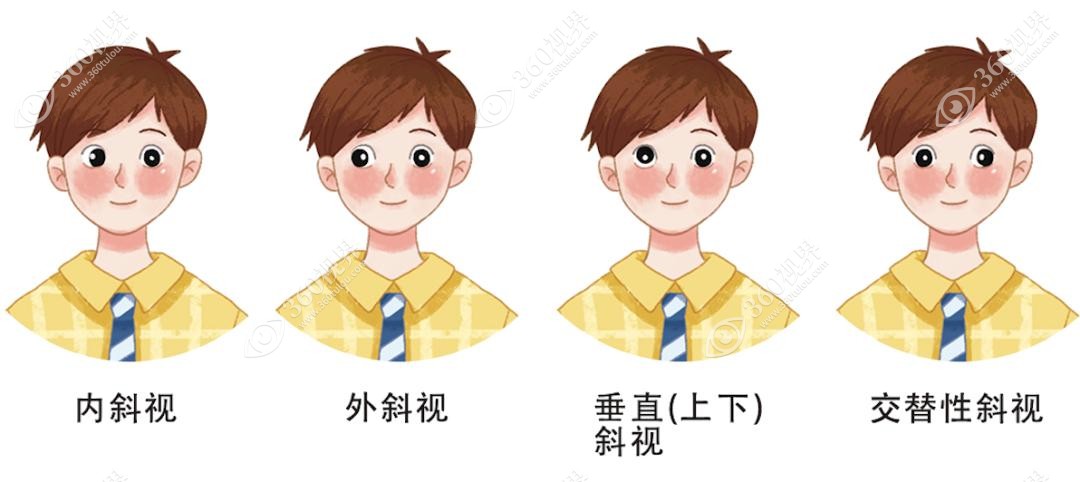 斜视可能是眼部疾病或损伤造成的