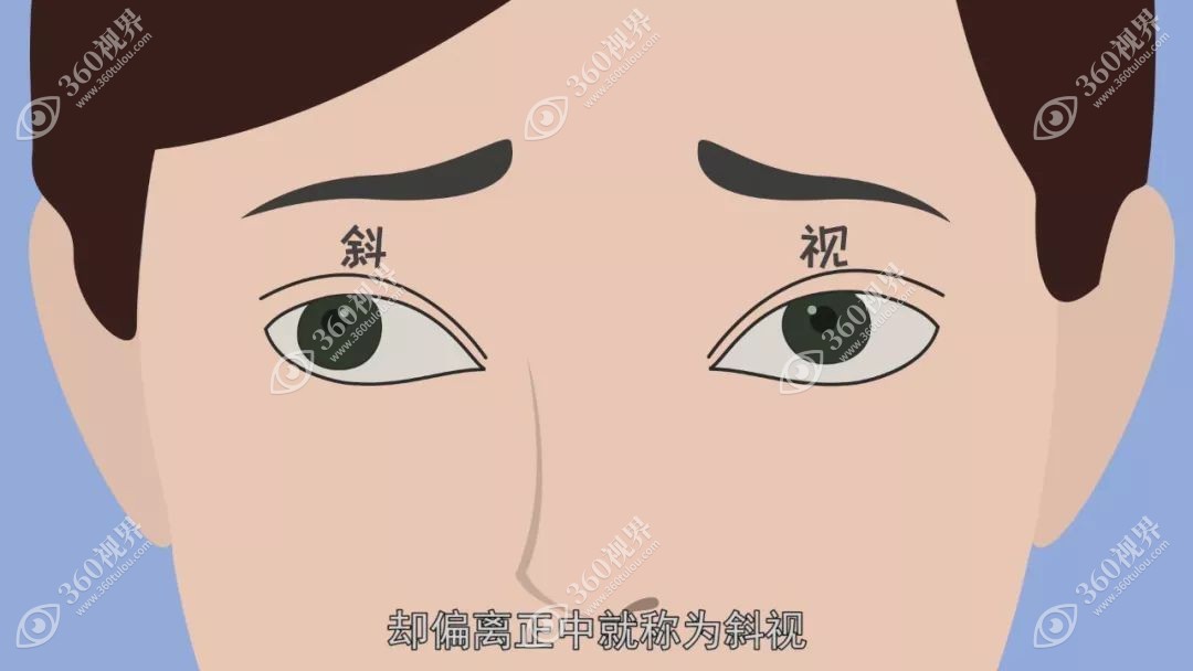 斜视可能是屈光不正造成的