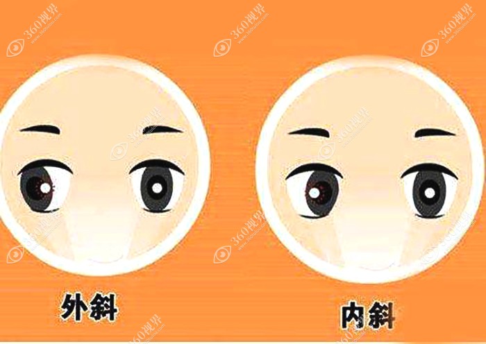 斜视可能是神经肌肉发育异常造成的