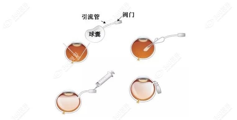 玻璃体球囊植入术流程