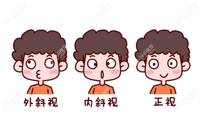 斜视可能是遗传因素造成的
