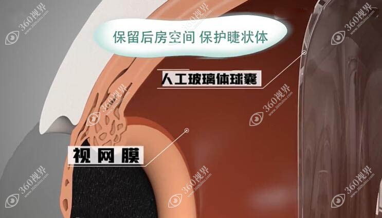 人工玻璃体球囊植入后