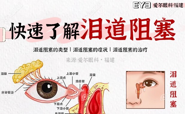 爱尔眼科做泪道疏通的手术怎么样