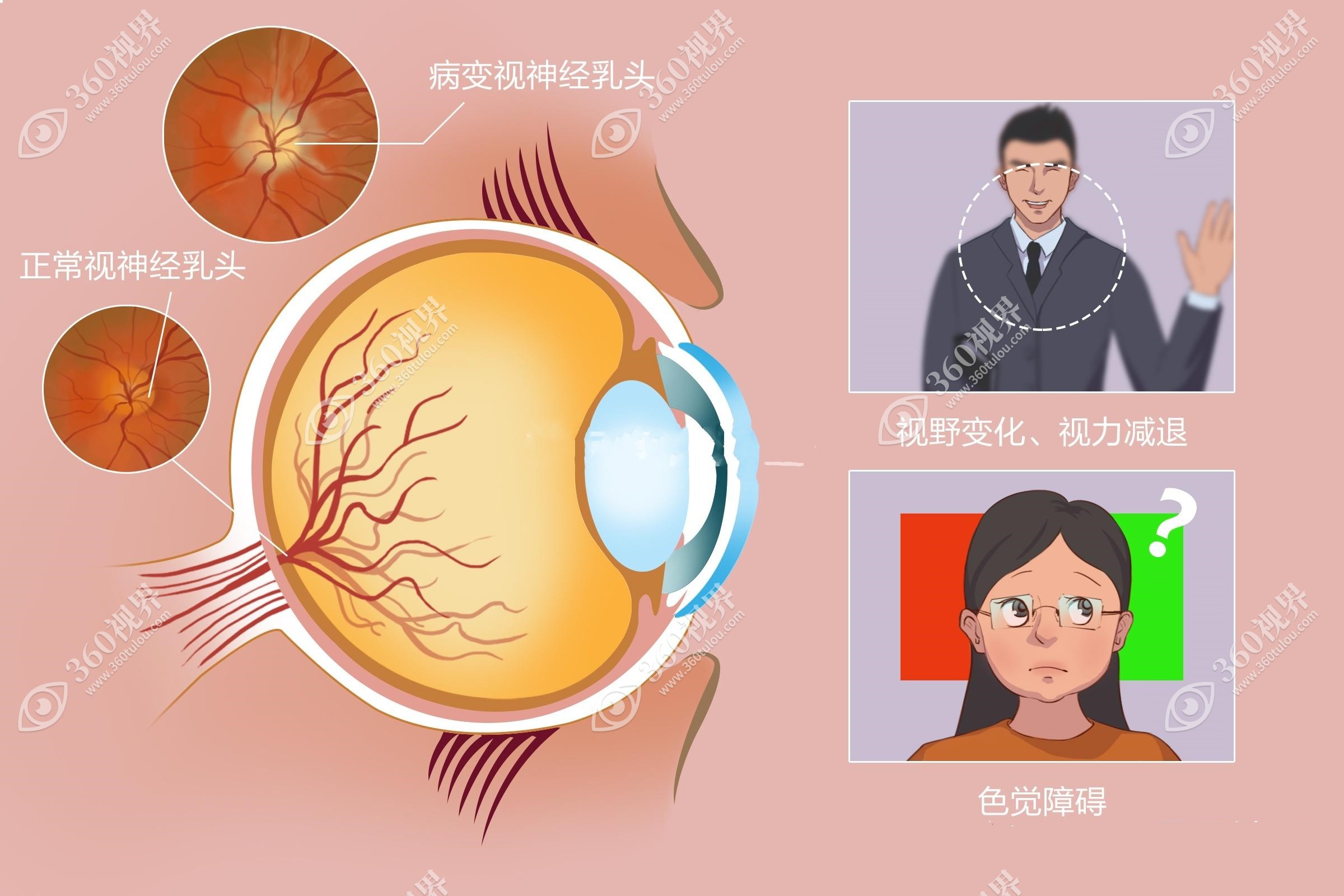 视神经萎缩可以通过针对病因治疗来改善视力。360tulou.com