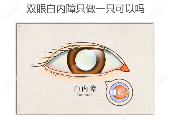 双眼白内障只做一只可以吗