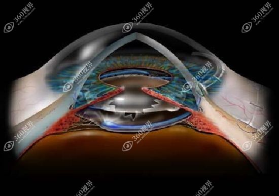 美国强生眼力健晶体型号多元化。360tulou.com