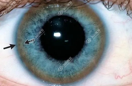 一文告知！kf环的眼科表现以及kf环与正常眼睛区别
