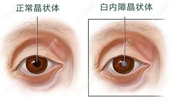山东近视眼手术滨州滨视眼科医院比较好。360tulou.com