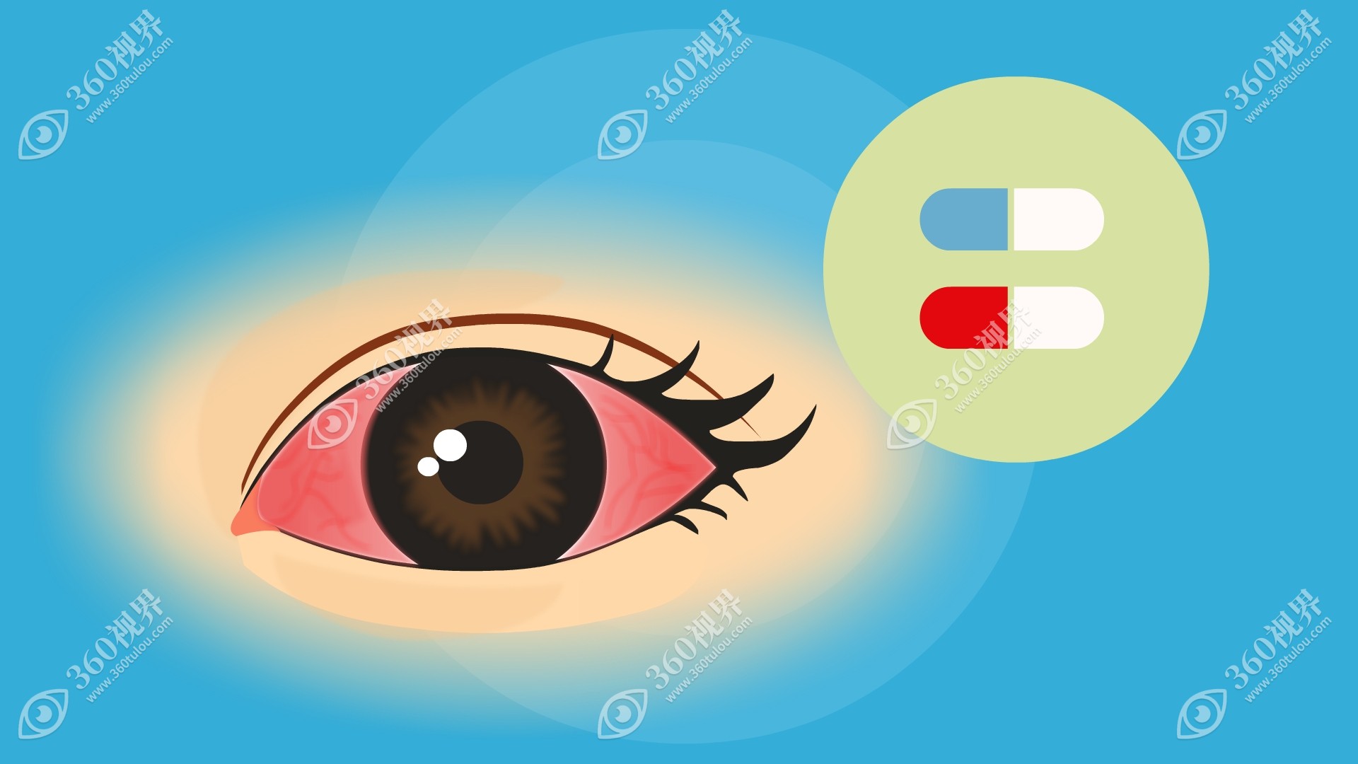 单只眼睛出血要警惕四种疾病?一只眼睛出血是结膜炎/青光眼