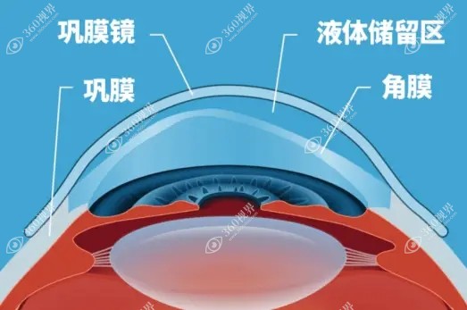巩膜镜适用于屈光不正（高度散光、近视和远视）。360tulou.com