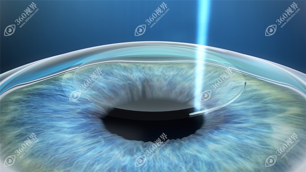 近视手术后视力一般可以达到1.0，但也有0.8的度数存在。360tulou.com