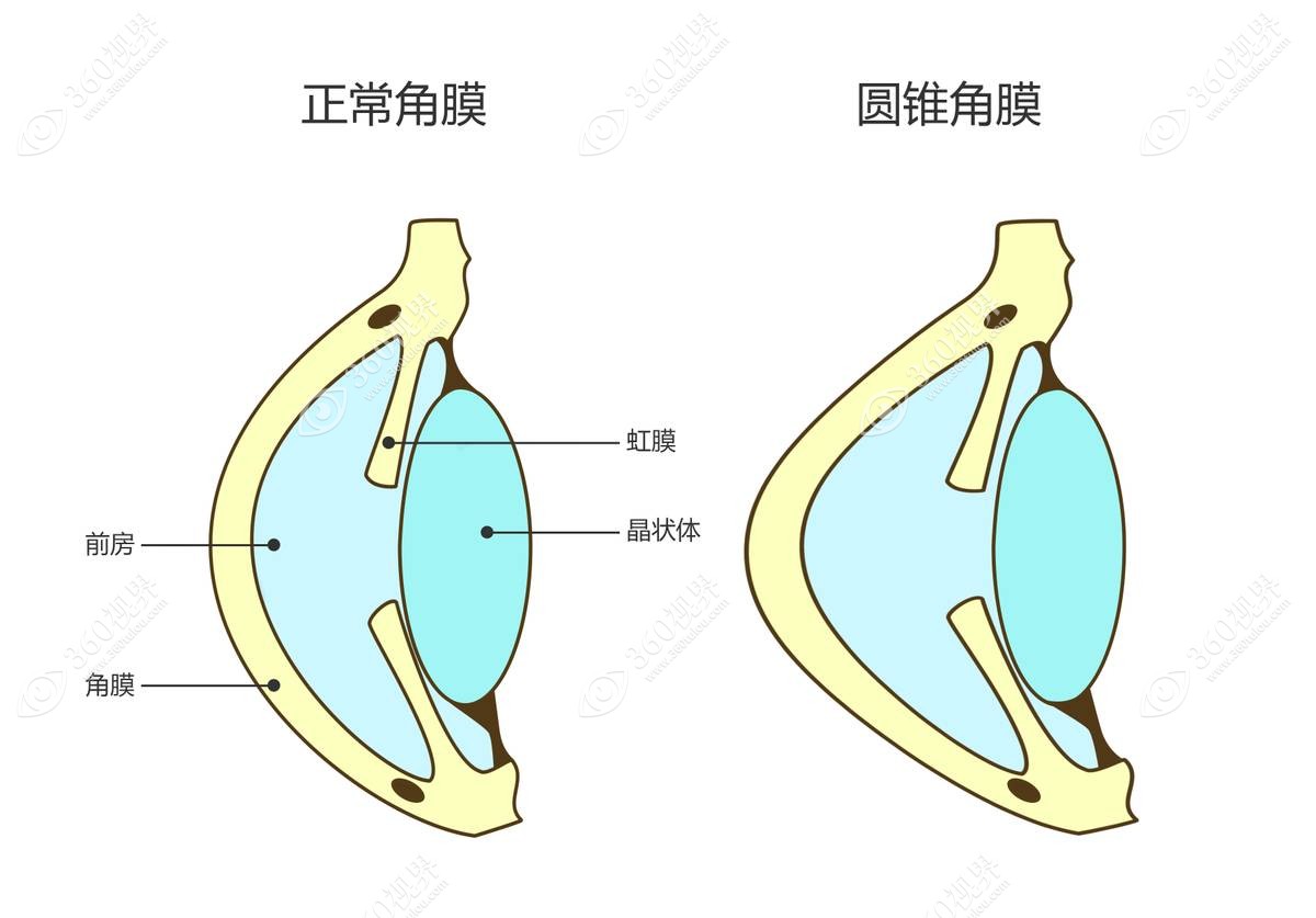 预防圆锥角膜的措施