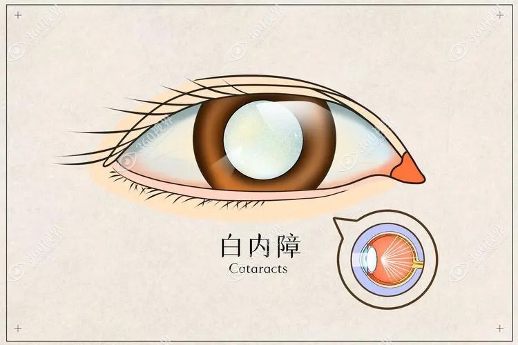 白内障超声乳化手术后视力模糊可能是因为后发性白内障