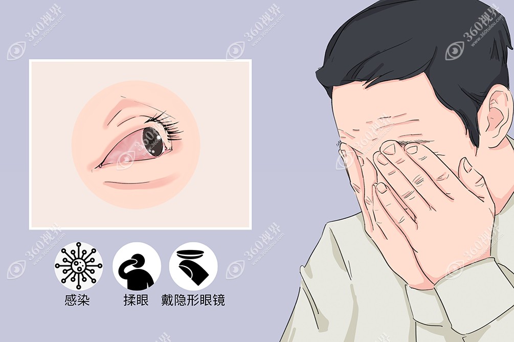 感染因素微生物感染是角膜炎常见的病因