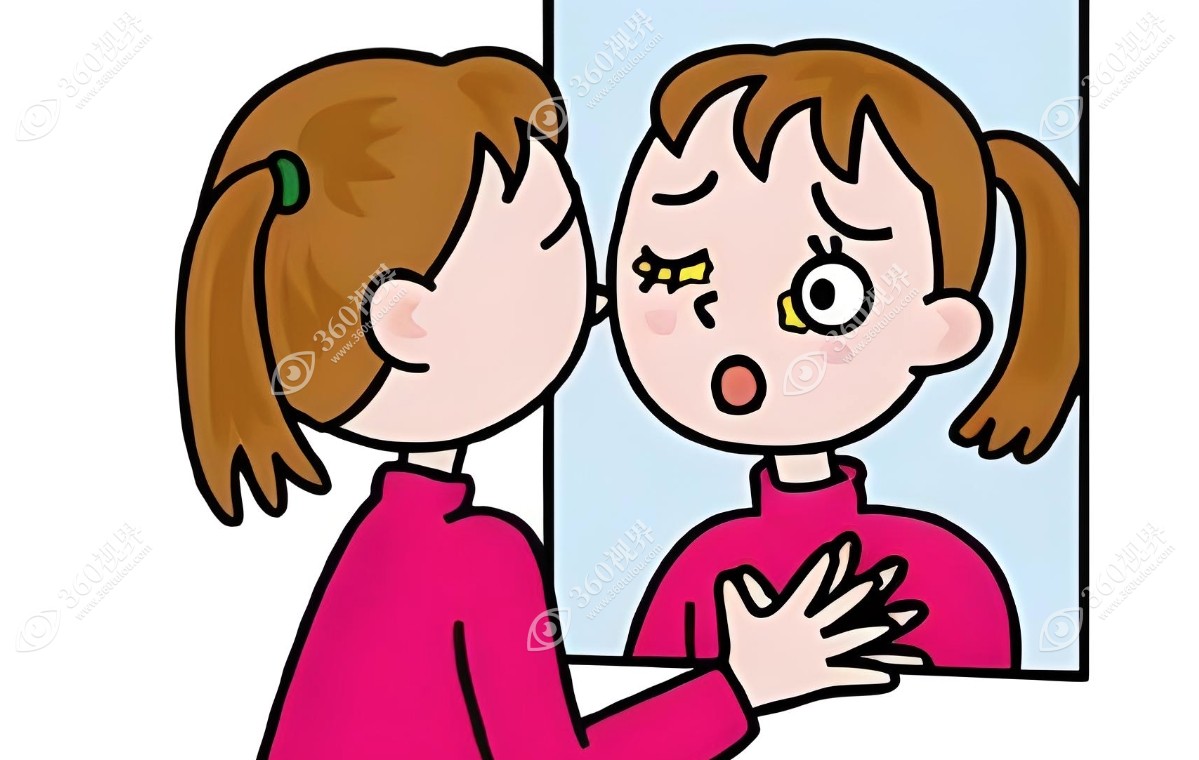 角膜形态变化