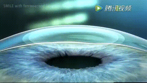 沈阳近视眼手术