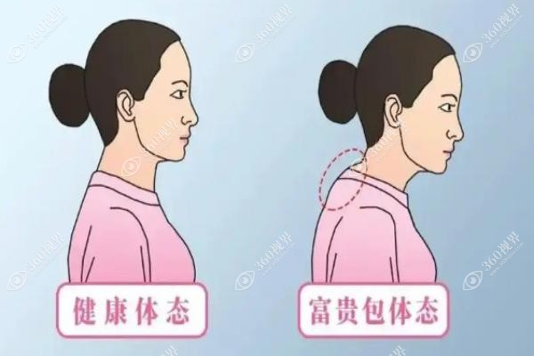 富贵包外科手术多少钱