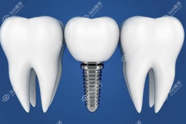 种植牙5年后真实感受满嘴牙没有了,能镶牙齿吗 种植牙5年后真实感受满嘴牙没有了,能镶牙齿吗