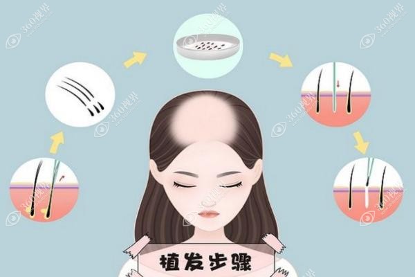 厦门植发医院排名前三的有哪些