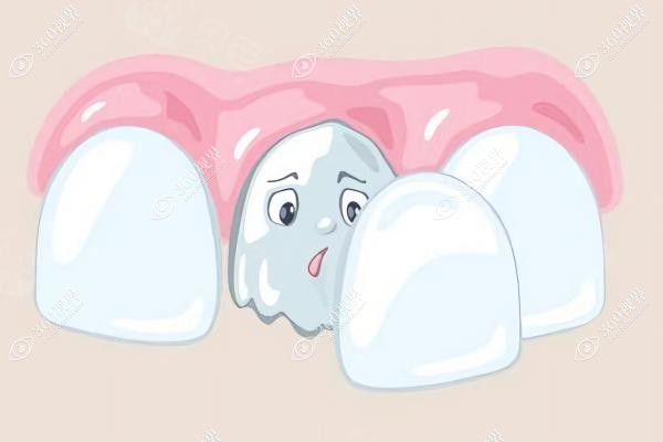 牙齿瓷贴面的优缺点