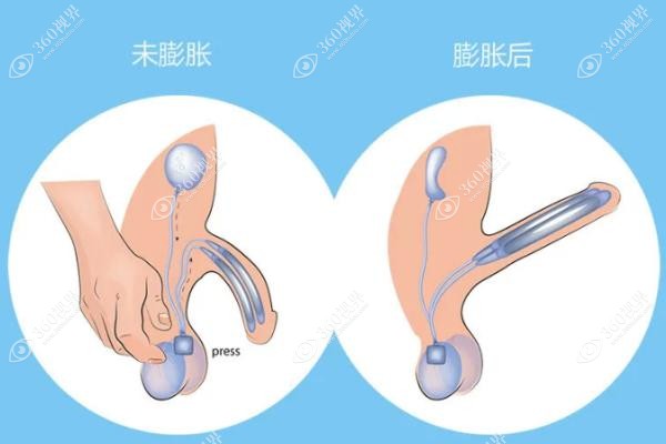 男性私密弯曲矫正手术费用.jpg