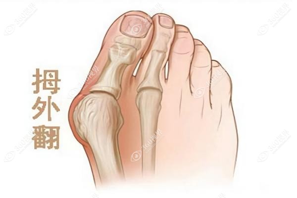 大脚骨微创手术真实经历