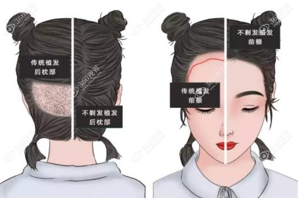 植发口碑怎么查