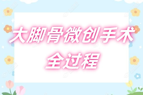 大脚骨微创手术全过程：真实经历+恢复记录+术后感受一起分享~