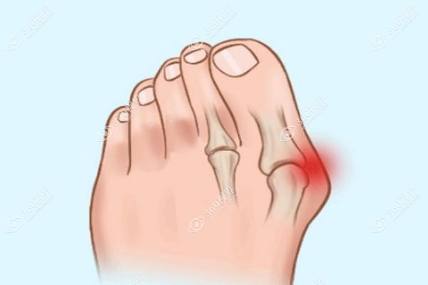 北京圣嘉新医院做大脚骨怎么样