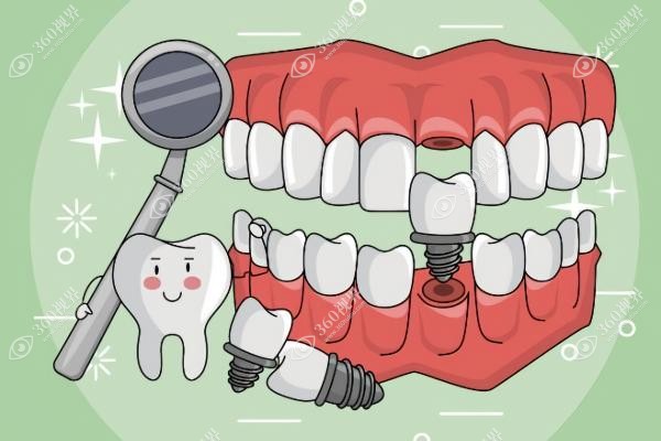 全口吸附性义齿和普通义齿的区别