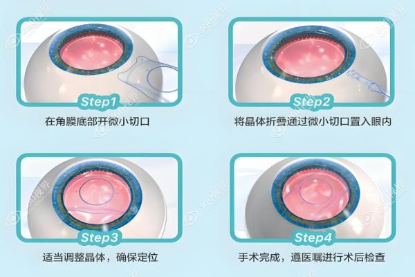 郑州做近视手术需要多少钱