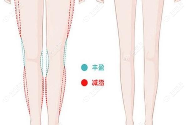 直腿术要多少钱怎么做