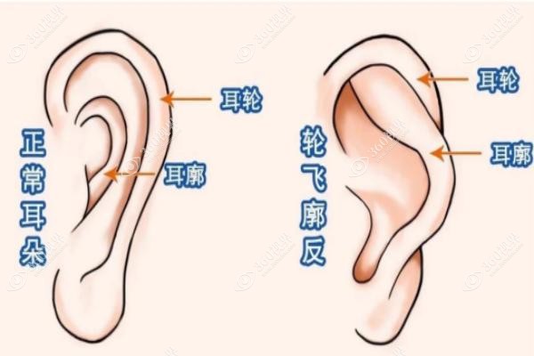 反骨耳朵整形多少钱？.jpg