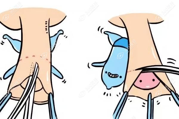 变性手术24小时免费咨 询