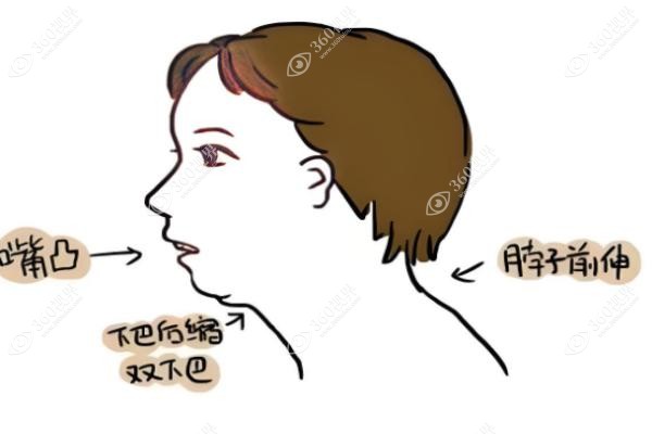 儿童下颌后缩判断标准.jpg