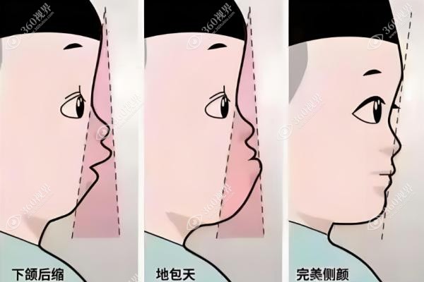 儿童下颌后缩怎么矫正？家长必看判断标准+矫正时间+矫正器戴价格全解密