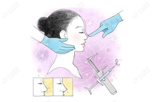 耳软骨隆鼻和肋骨隆鼻哪个好?鼻尖妈生感VS鼻梁挺拔一次说清<span style=