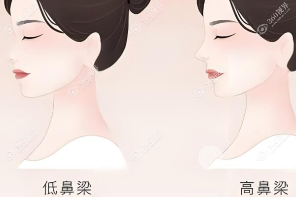 耳软骨隆鼻和肋骨隆鼻哪个好?鼻尖妈生感VS鼻梁挺拔一次说清<span style=