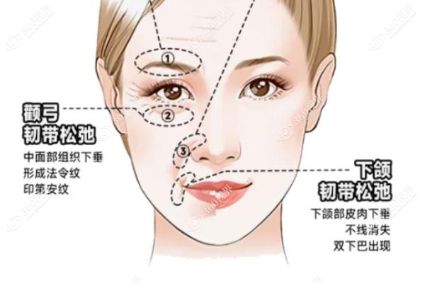 打耳前韧带提升选择什么玻尿酸？.jpg