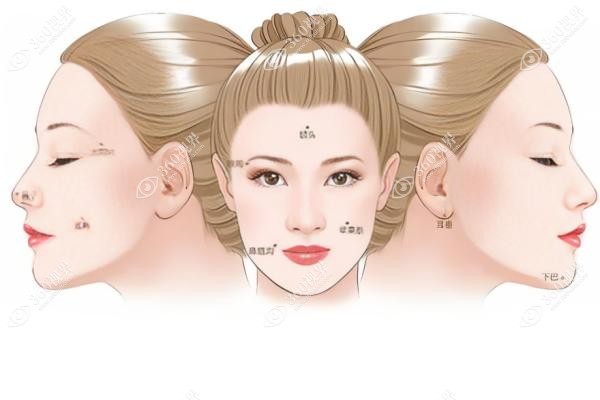 耳前韧带提升会使脸变宽吗？防馒化攻略：材料点位把控好+玻尿酸别选错！