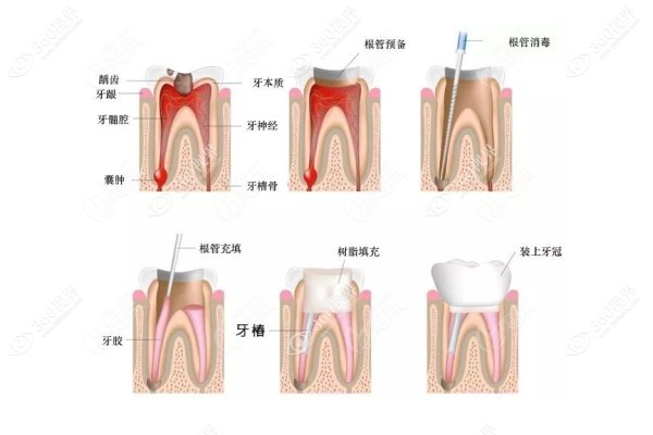 牙齿掉了，只剩牙根怎么办